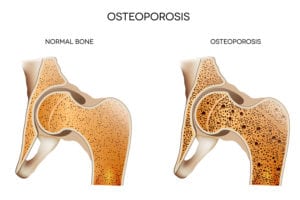 Home Care in La Canada CA: Osteoporosis
