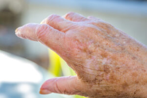 Elder Care: Skin Cancer